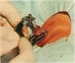 Excision of the foreskin distal to the junction of the Gomco bell and the clamp.